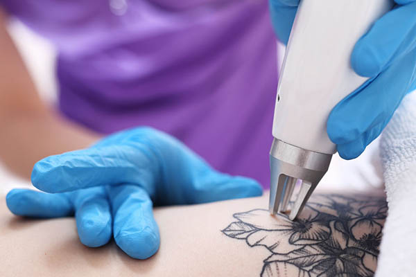 Trattamento di rimozione tatuaggi con laser