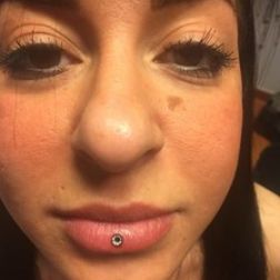 microdermal-3