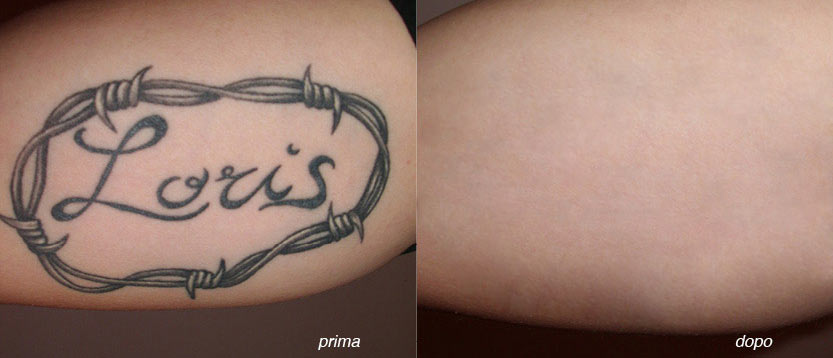Tattoo Removal